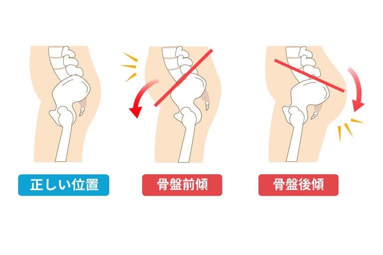 骨盤の歪みが引き起こす不調