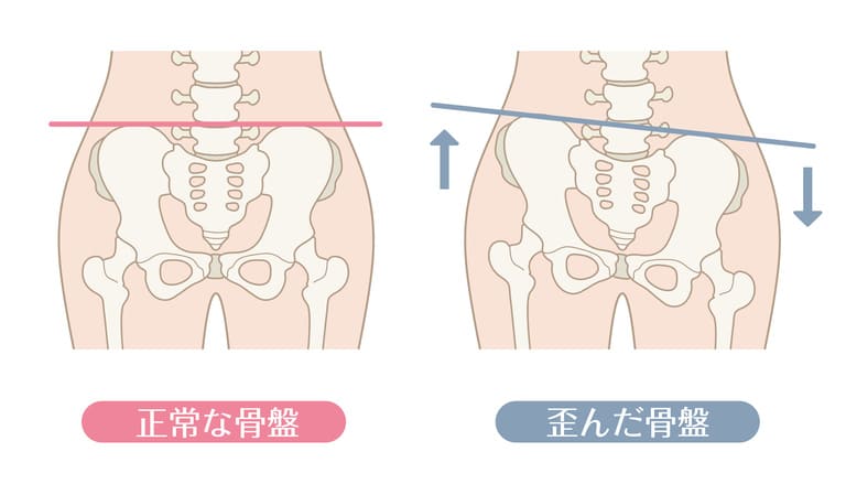 骨盤矯正とは